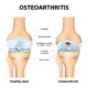 Osteoarthritis: Fakta, Gejala, dan Pengobatan Paling Ideal