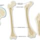 Osteogenesis Imperfecta: Gejala, Diagnosis, dan Metode Perawatan