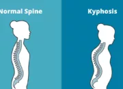 Kyphosis: Gejala, Diagnosis, dan Cara Mengatasi Kelainan Punggung