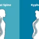 Kyphosis: Gejala, Diagnosis, dan Cara Mengatasi Kelainan Punggung