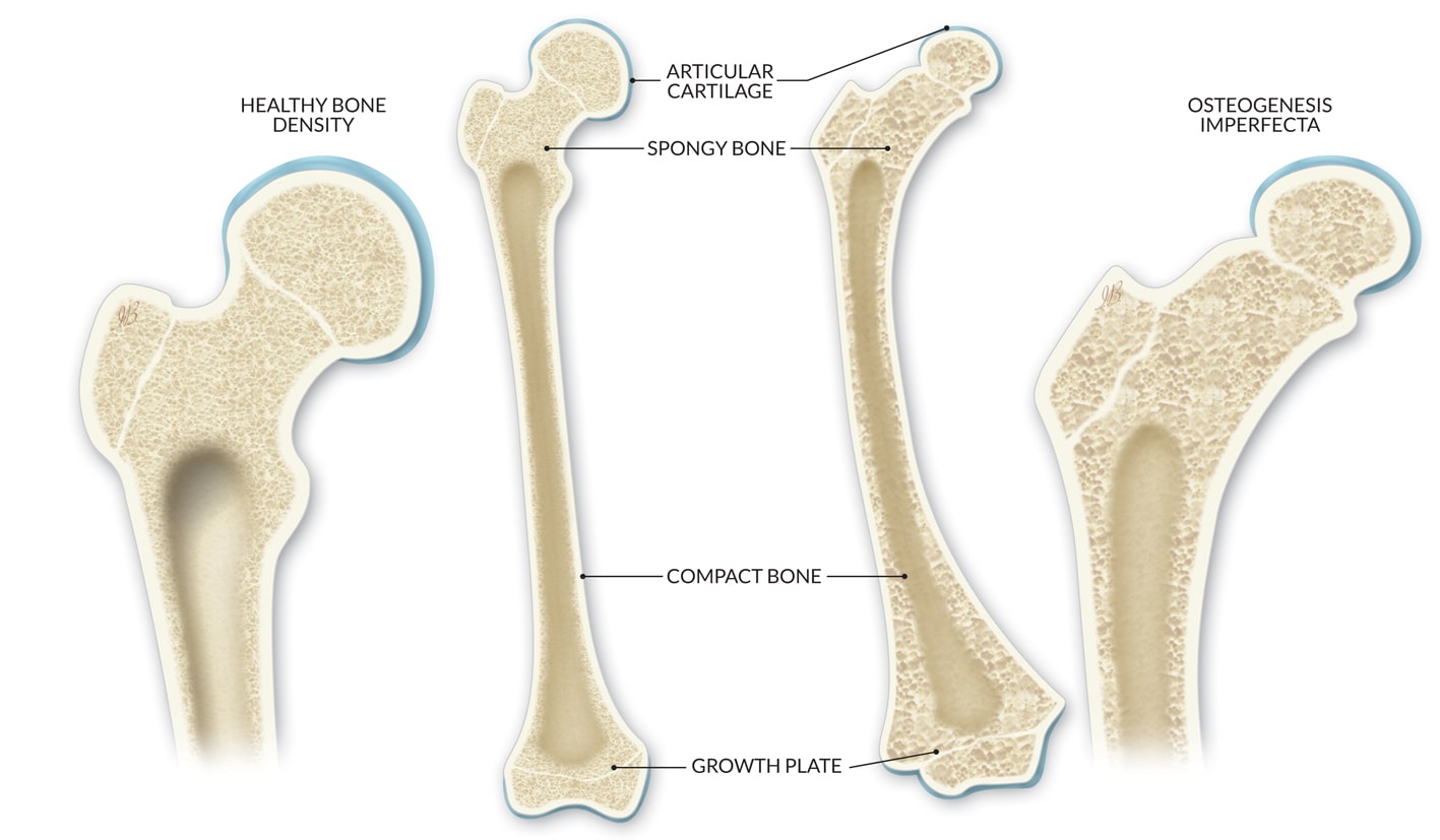 Osteogenesis Imperfecta: Gejala, Diagnosis, dan Metode Perawatan