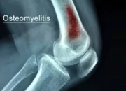 Osteomyelitis: Mengenal Infeksi Tulang dan Prosedur Pengobatannya