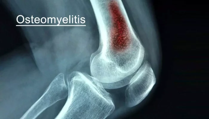 Osteomyelitis: Mengenal Infeksi Tulang dan Prosedur Pengobatannya