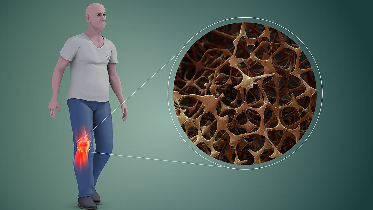 Osteoporosis: Gejala, Penyebab, dan Cara Pengobatan